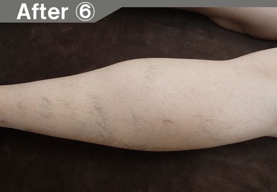 鼻下、アゴ周りののヒゲ脱毛効果after