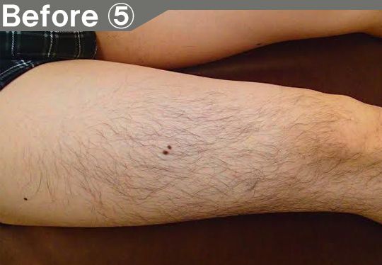 口周りのヒゲ脱毛効果before