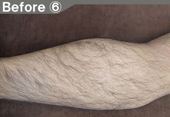 鼻下、アゴ周りののヒゲ脱毛効果before